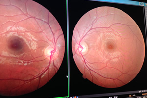 近視・遠視・乱視・老眼と関連する病気